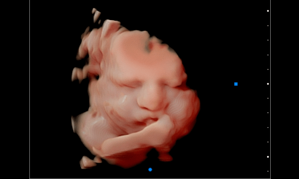 Imagen nítida de ecografía 5d bebe dentro del vientre