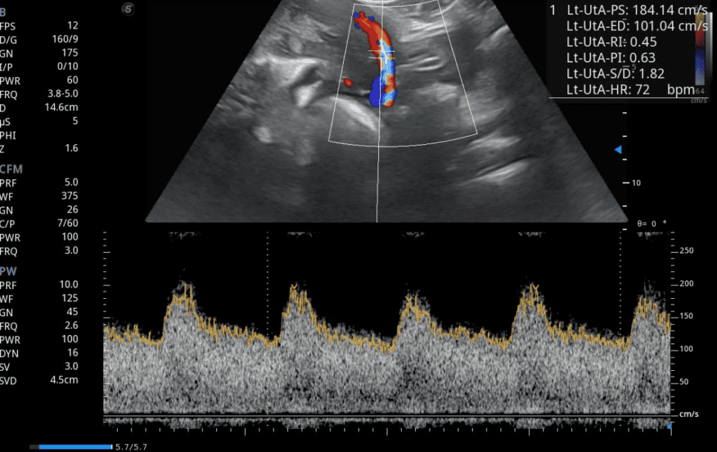 Detección temprana de problemas de salud fetal con ecografía Doppler