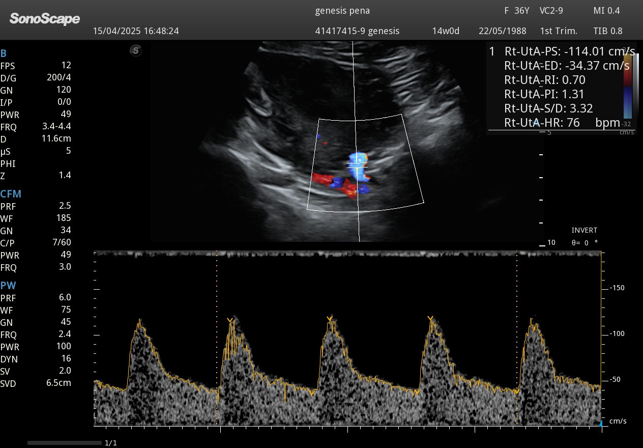 Doppler flujo umbilical fetal embarazo