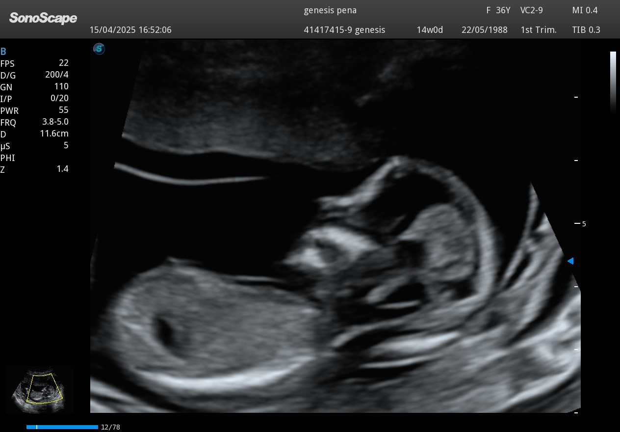 Perfil fetal en ecografía Doppler obstétrica 2D
