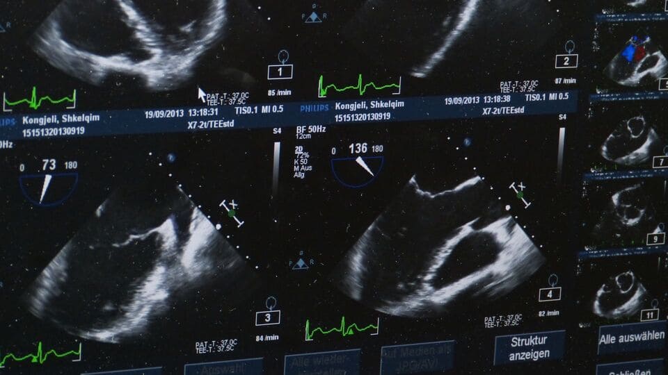 Pantalla de ecografía con imágenes médicas utilizadas en elastografía mamaria