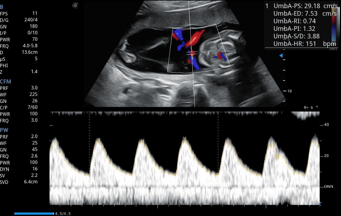 Doppler del Ductus Venoso y Arteria Umbilical: guía para detectar riesgo fetal temprano