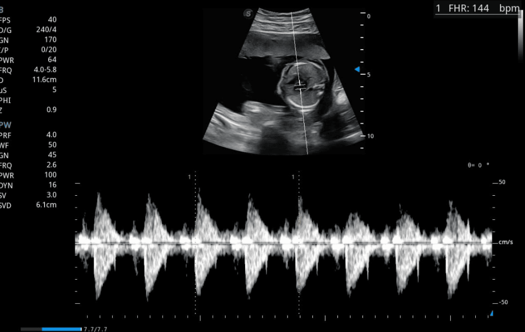 Doppler del ductus venoso fetal con espectro de ondas S, D y a para evaluar función cardiovascular y bienestar fetal